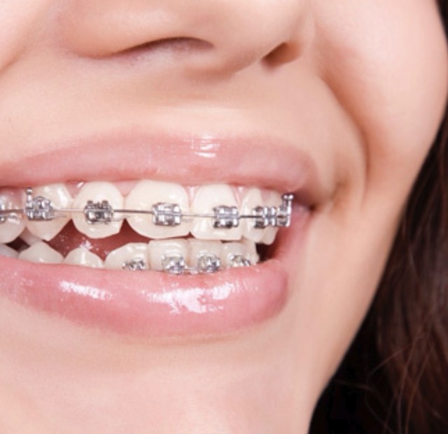 Металлические брекеты Mini Diamond