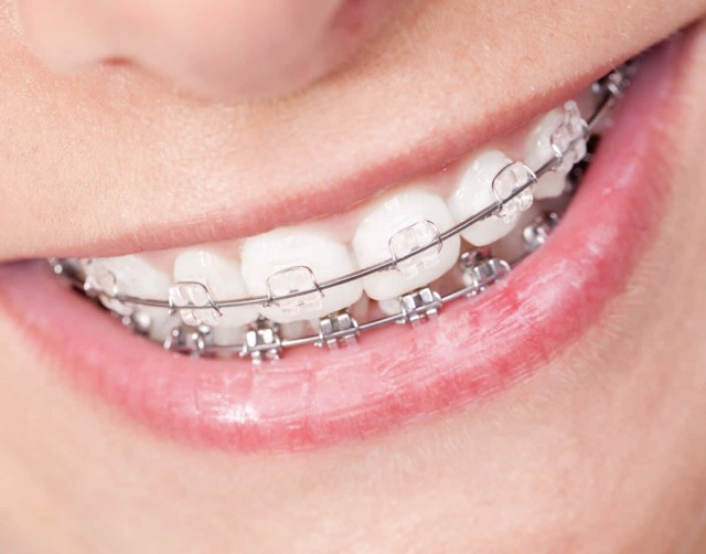 Керамические вестибулярные брекеты