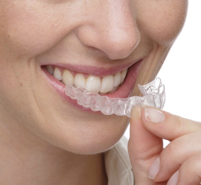 Элайнеры FlexiLigner