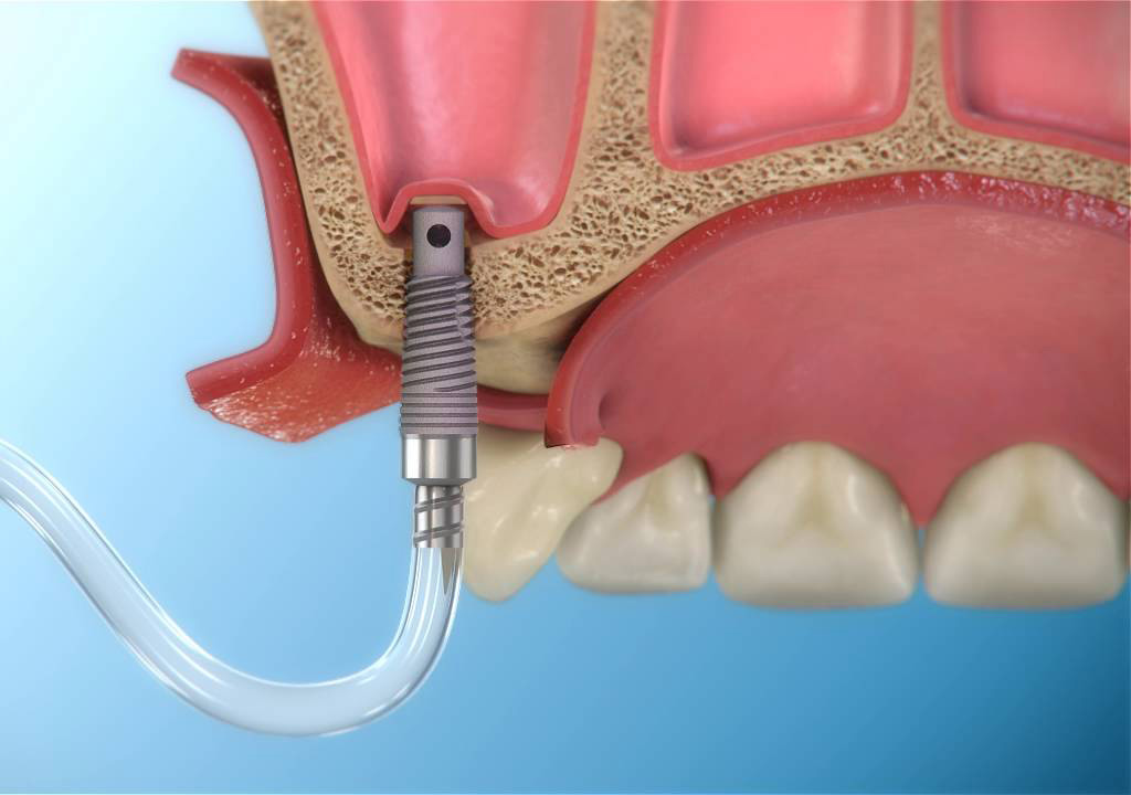 Синус-лифтинг